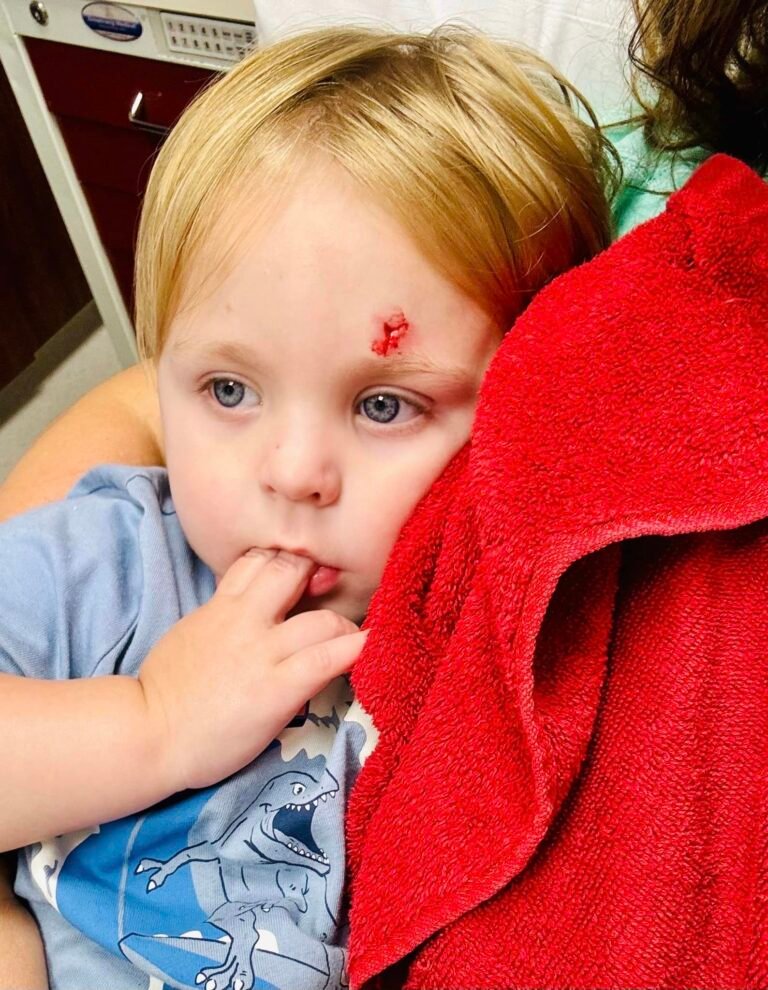 Head wounds in Kids- What to Do!